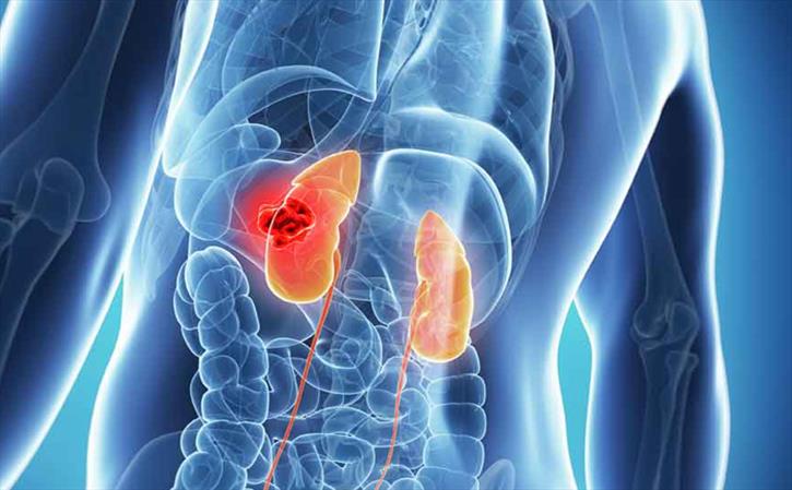 End Stage Renal Failure- Homeopathy Treatment 